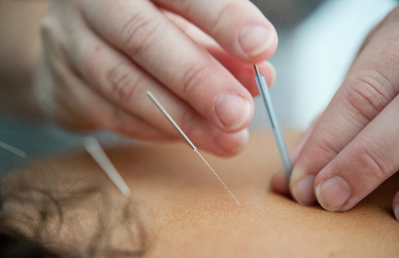 Acupunctuur